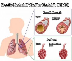 koah-nedenleri-belirtileri