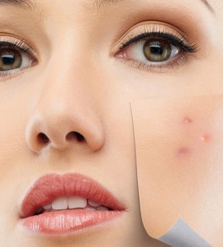 Akne Tedavisi Yöntemleri Nelerdir?