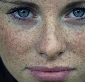 İbrahim Saraçoğlu Çil Tedavisi İbrahim Saraçoğlu Çil Tedavisi