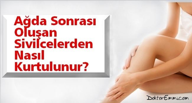 Ağda Yapıldıktan Sonra Sivilceler Nasıl Geçer 2