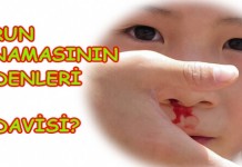 Burun Kanaması İle İlgili Bilmeniz Gerekenler Burun Kanaması 2