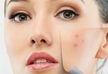 Akne Tedavisi Yöntemleri Nelerdir? Akne Tedavisi Yöntemleri Nelerdir?