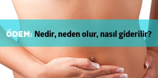 Ödem Nedir?