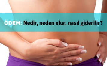 Ödem Nedir?