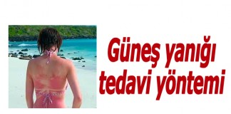 Birinci derece ve ikinci derece güneş yanığı arasındaki fark nedir? Nasıl tedavi edilir? Güneş yanığı sonrasında kaşıntıyı önlemek için ne